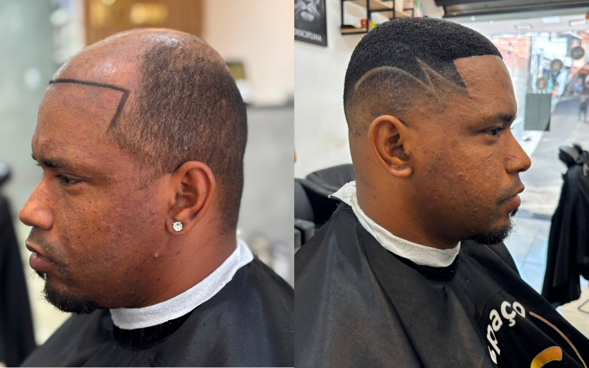 Resultado 1: comparação de antes e depois da prótese capilar fio a fio