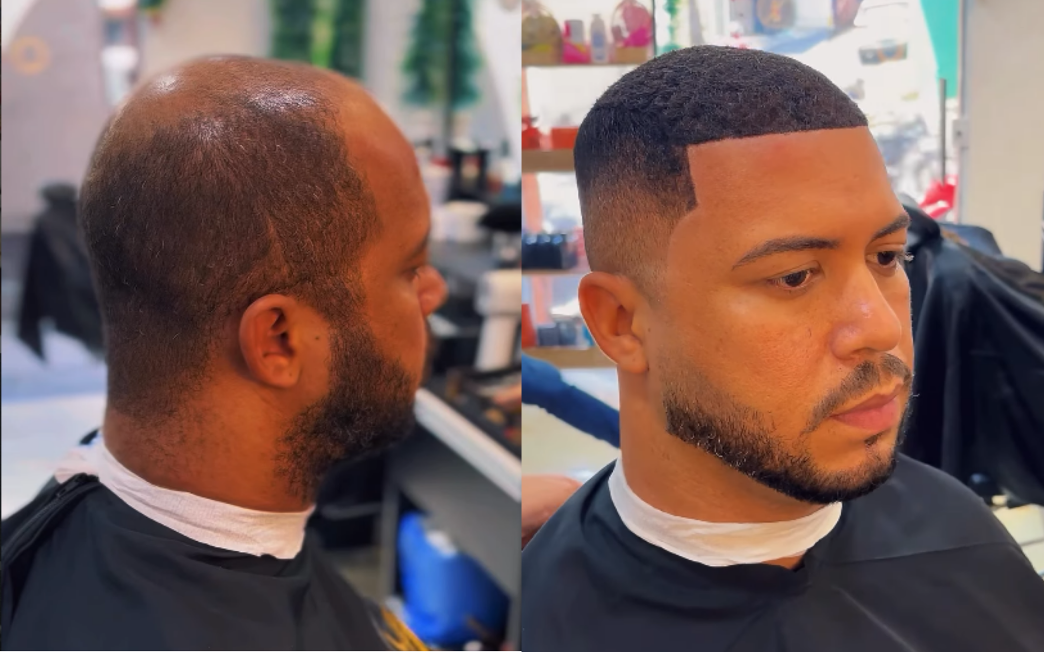 Resultado 2: comparação de antes e depois da prótese capilar fio a fio