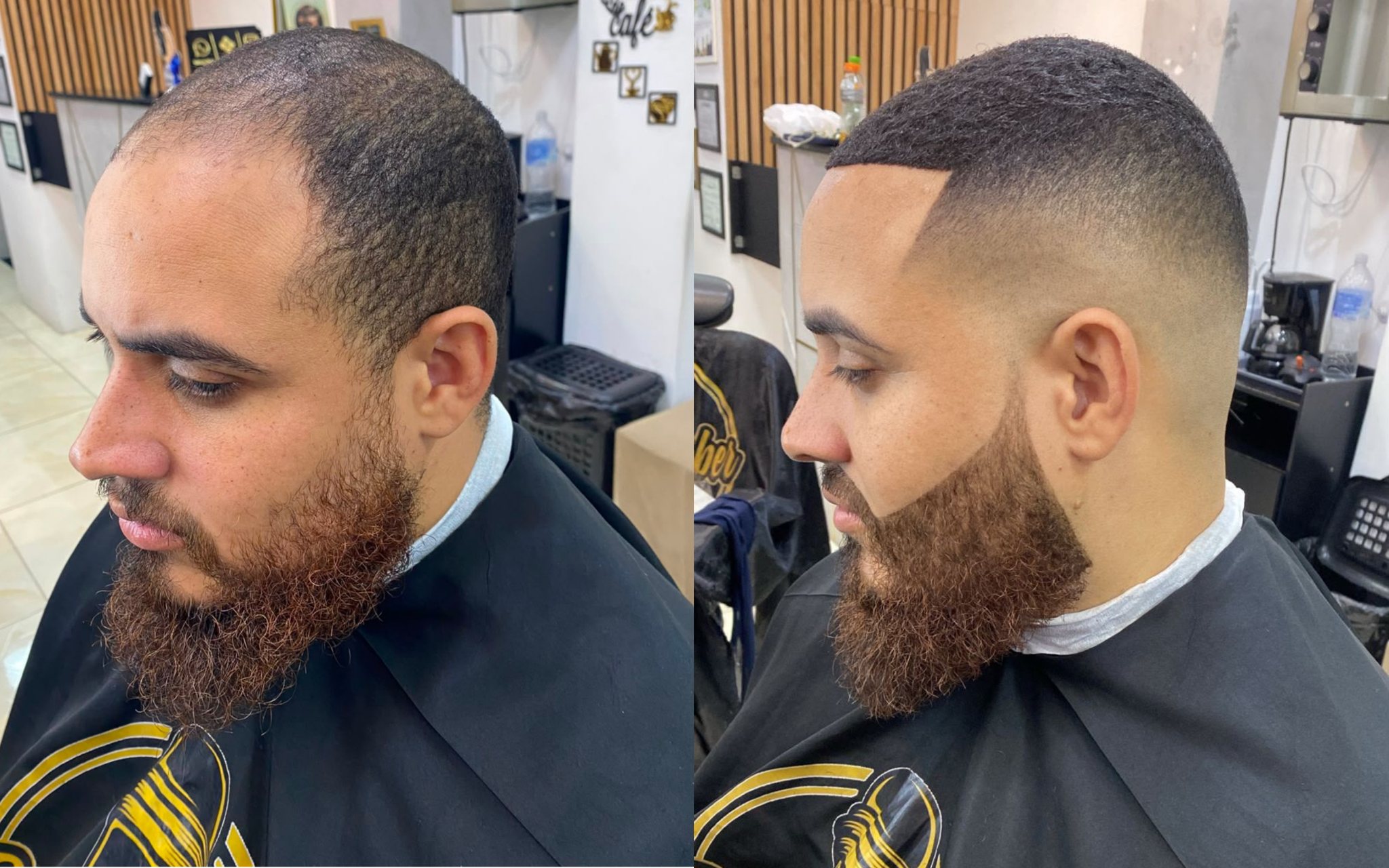 Resultado 3: comparação de antes e depois da prótese capilar fio a fio