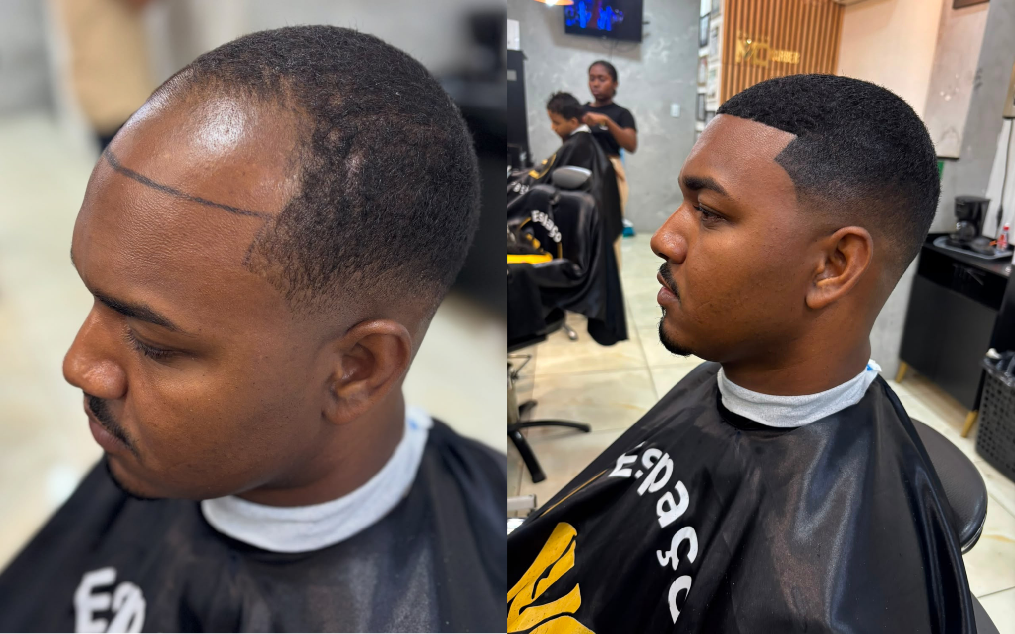 Resultado 4: comparação de antes e depois da prótese capilar fio a fio